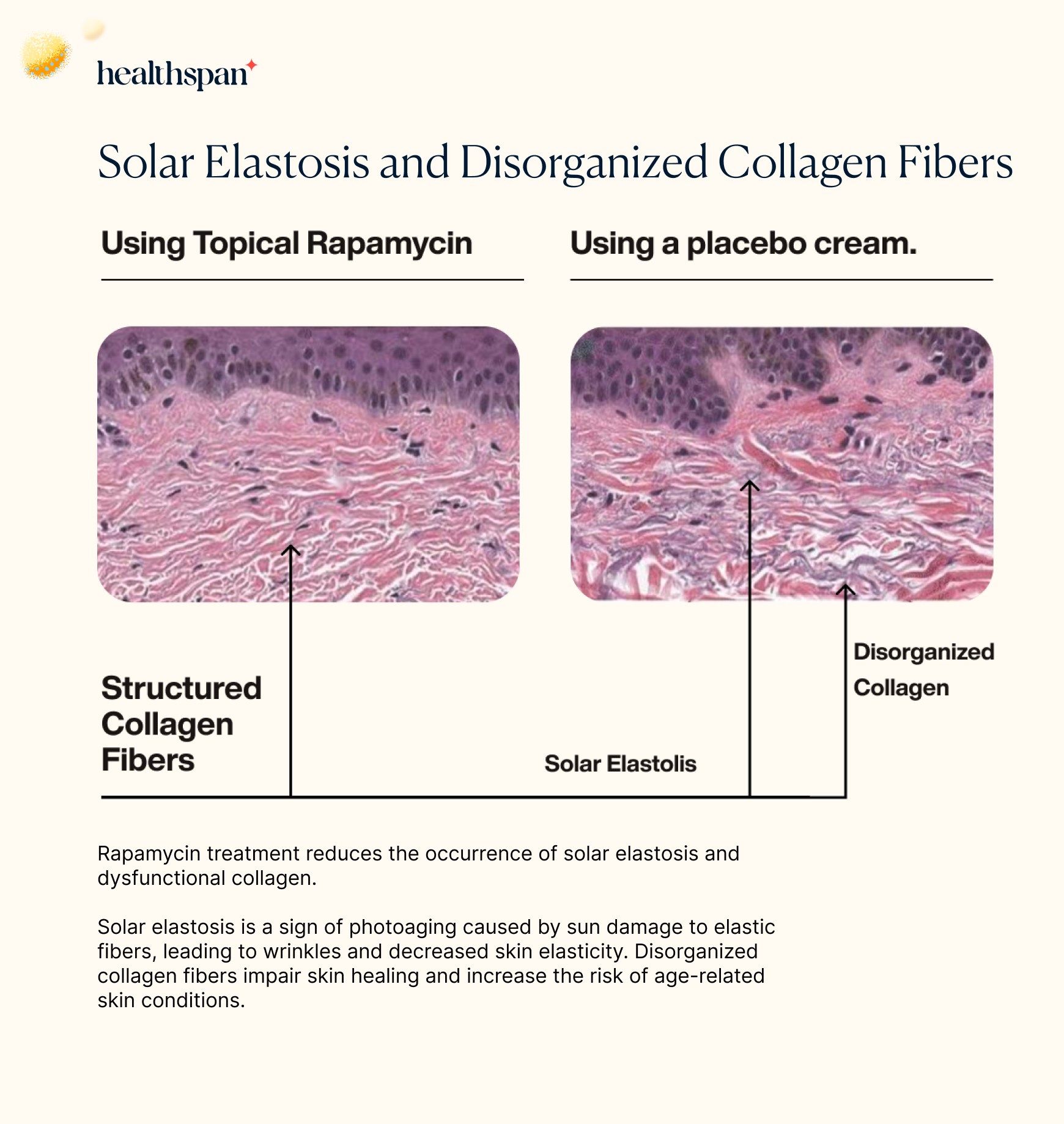 Rapamycin and Solar Elastosis