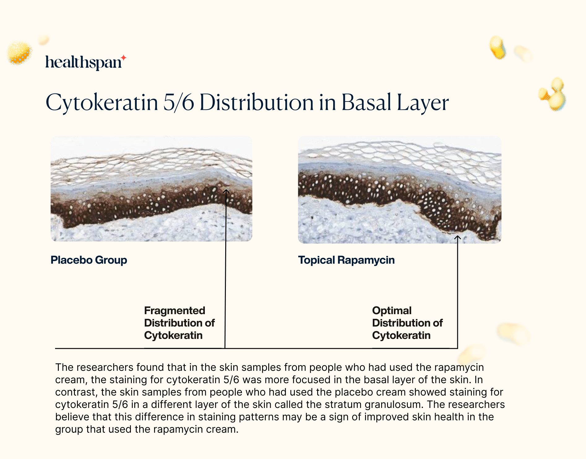 Cytokeratin 5/6 Distribution in the Basal Layer