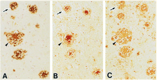 Photomicrographs of serial sections of the hippocampus from an AD brain.