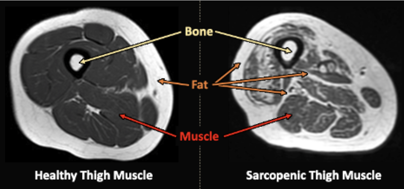 MRI cross-sections of a relatively young and healthy thigh muscle (left) and an older, sarcopenic thigh muscle (right)