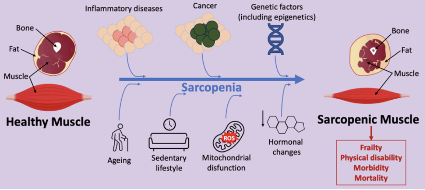 Schematic representation of major factors contributing to sarcopenia