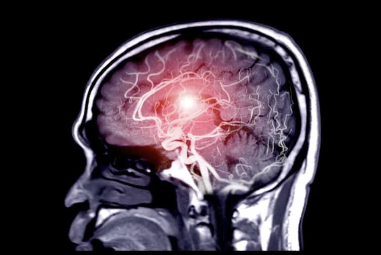 Blood Flow to Brain Function: How GLP-1 Therapies May Reduce Dementia Risk | Healthspan Blood Flow to Brain Function: How GLP-1 Therapies May Reduce Dementia Risk | Healthspan