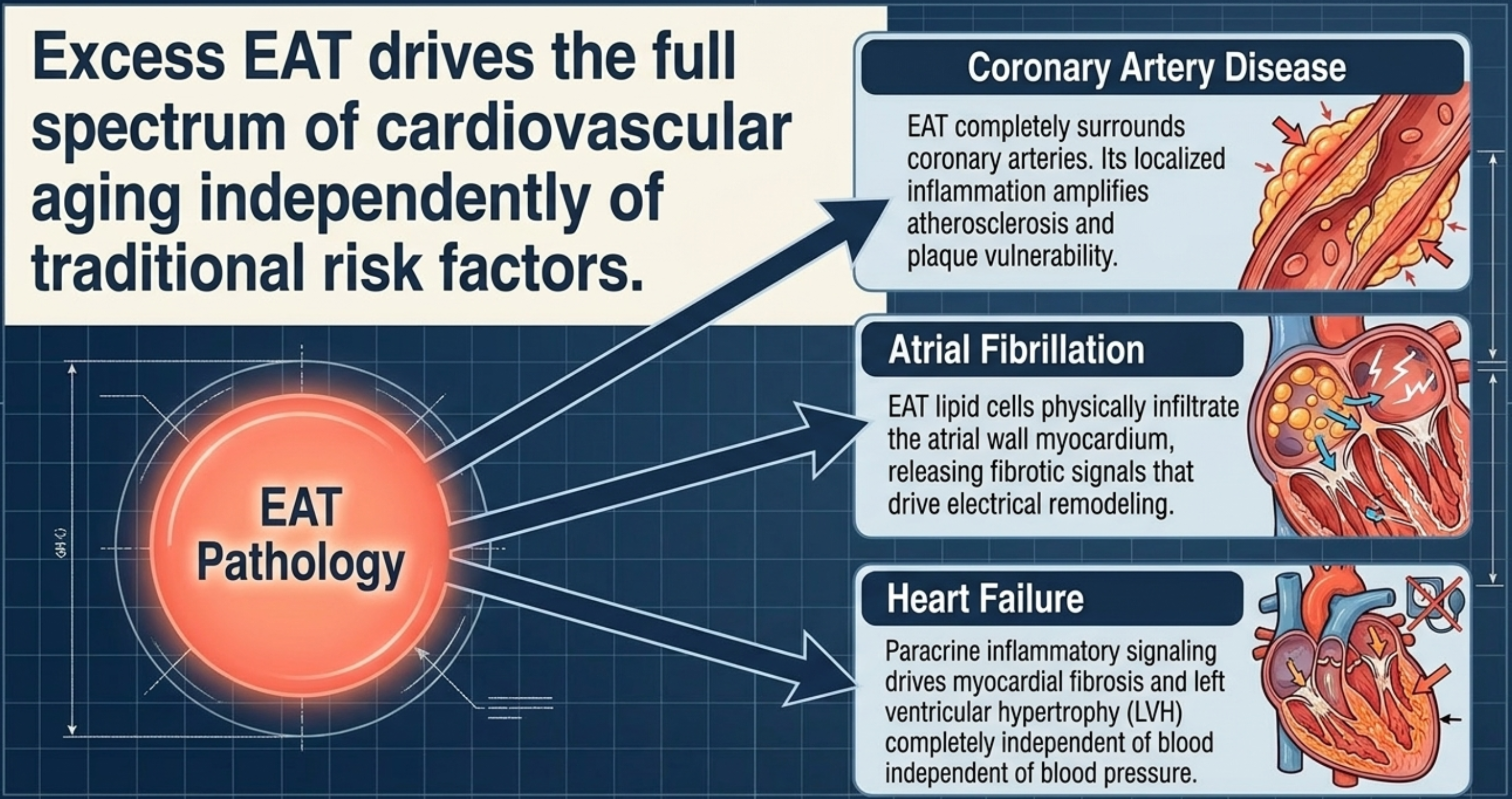 Diagram shows how excess EAT pathology causes coronary artery disease, atrial fibrillation, and heart failure.