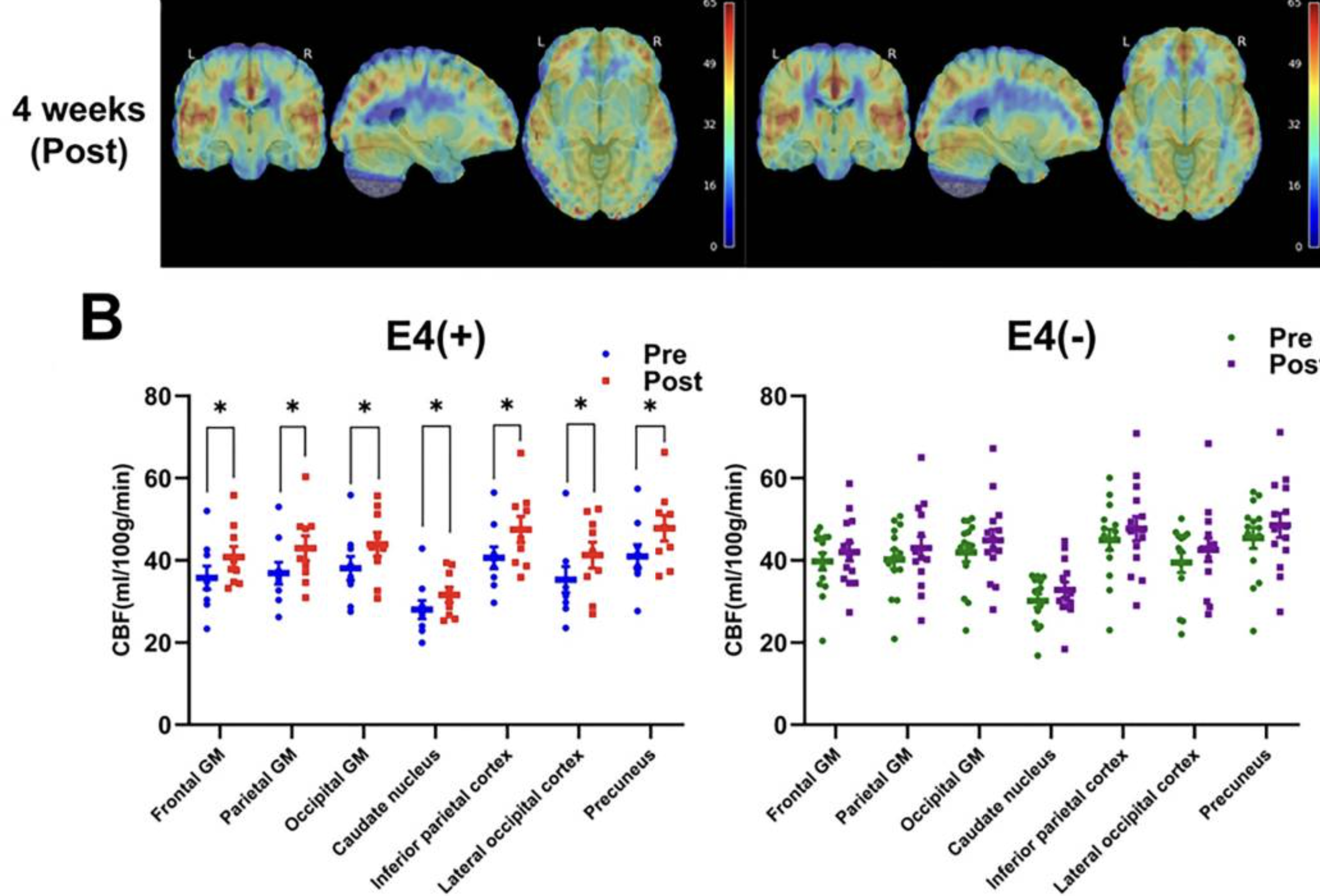 Brain scans and plots compare CBF in E4 positive and negative groups.