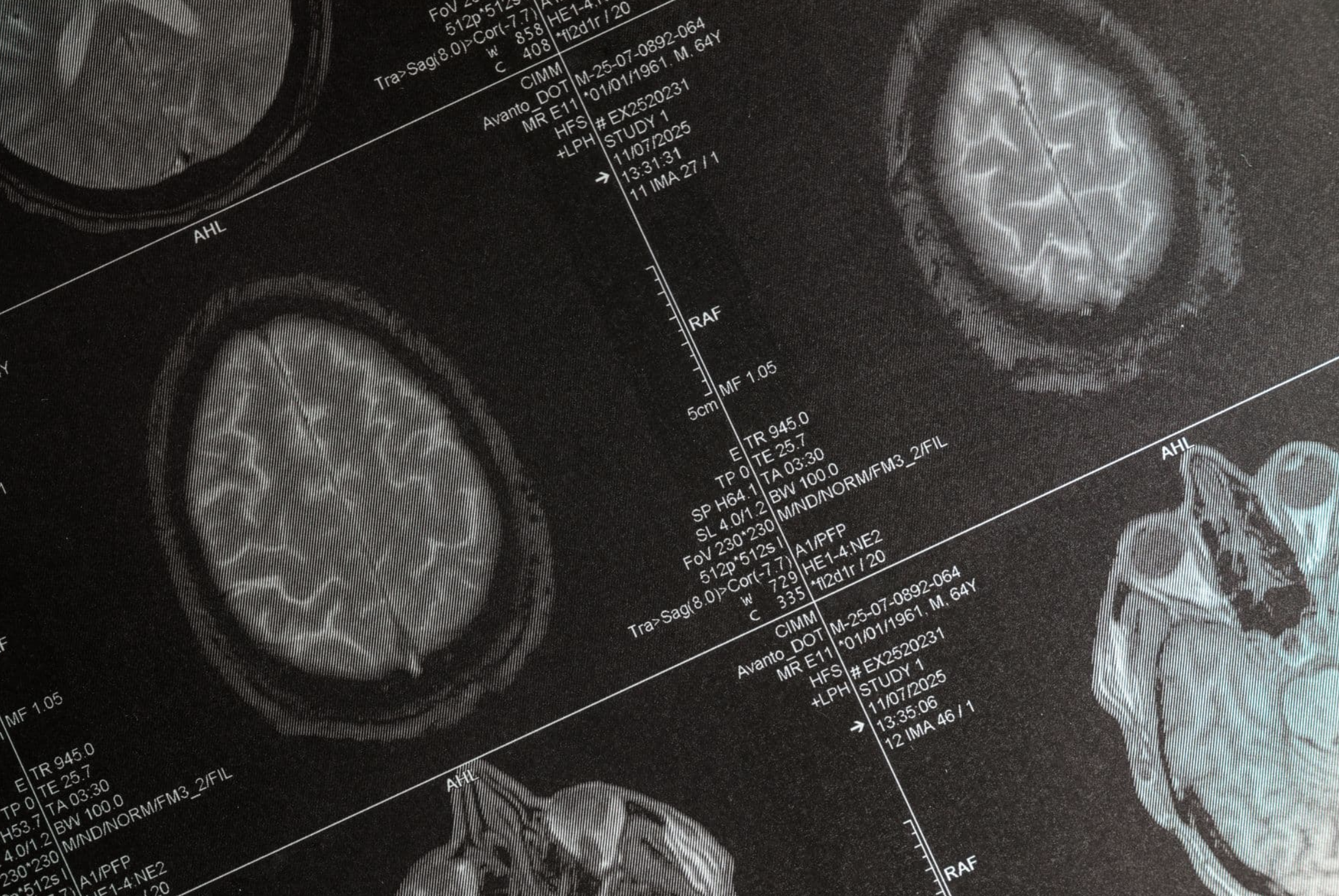 Rapamycin and Cerebral Blood Flow in APOE4 Carriers: An Early, Genotype ...